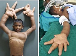 Kaleem, Bocah Bertangan Raksasa di India Jalani Operasi Pengecilan Tangan