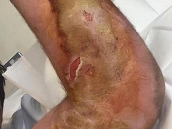 Digigit Laba-laba Langka, Muncul Balon di Lengan Pria Ini