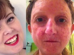 Foto Kampanye Penyakitnya Ditolak Medsos, Wanita Ini Tak Menyerah