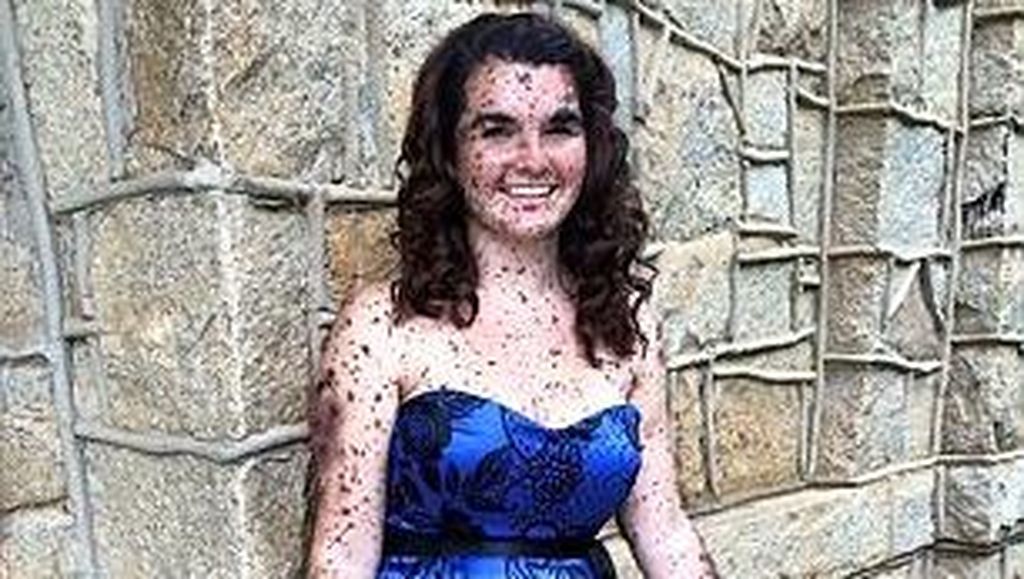 Hebat! Sekujur Tubuhnya Dipenuhi Tahi Lalat, Gadis Ini Tetap Percaya Diri Hebat! Sekujur Tubuhnya Dipenuhi Tahi Lalat, Gadis Ini Tetap Percaya Diri