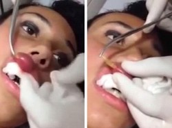 Bengkak, Ternyata Ada Belatung Tinggal dalam Bibir Wanita Ini