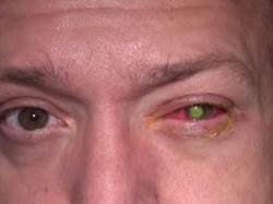 Lensa Kontak Tak Dicopot Saat Tidur, Pria Ini Kehilangan Penglihatan