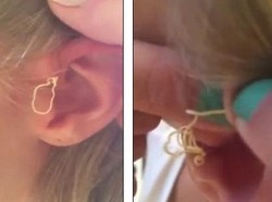 Ini yang Terjadi Saat Jerawat Umur 6 Tahun Dipencet untuk Pertama Kalinya