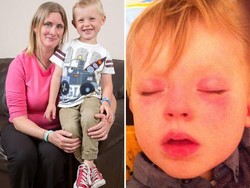 Idap Alergi Langka, Kulit Bocah Ini Jadi Gatal dan Ruam Tiap Kena Air