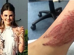 Bikin Henna Saat Berlibur ke Turki, Kulit Remaja Ini Malah Terbakar
