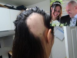 Stres Jelang Pernikahan, Rambut Calon Pengantin Rontok Hingga Botak