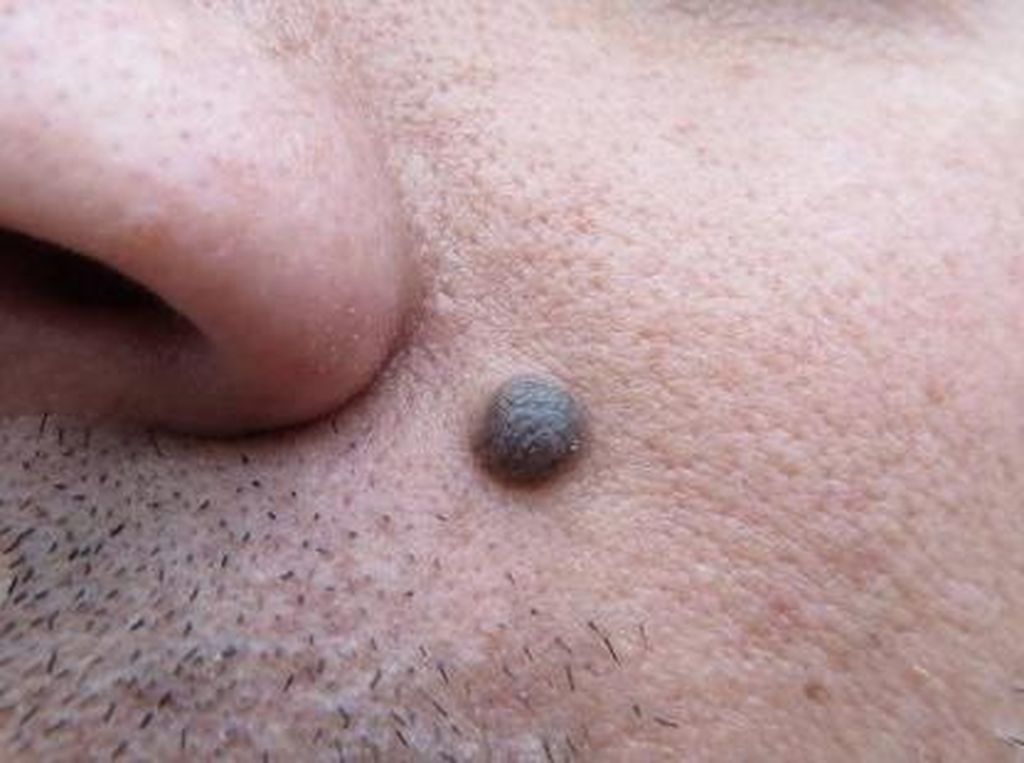 Kenali Basal Cell Carcinoma, Kanker Kulit Ganas yang Mirip Tahi Lalat Kenali Basal Cell Carcinoma, Kanker Kulit Ganas yang Mirip Tahi Lalat