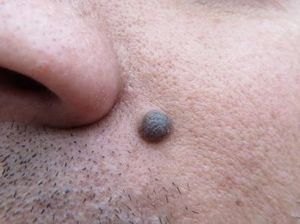 Asal-usul Nama Tahi Lalat dan Kaitannya dengan Kesehatan Asal-usul Nama Tahi Lalat dan Kaitannya dengan Kesehatan