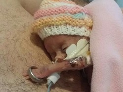 Menakjubkan! Bayi Mini karena Gangguan Plasenta ini Sanggup Bertahan Hidup