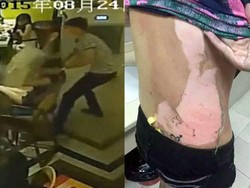 Disiram Air Mendidih, Wanita Ini Alami Luka Bakar Parah