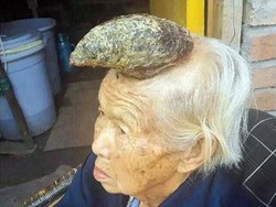 Mengenal Cutaneous Horn, Kondisi yang Bikin Manusia Bisa Bertanduk