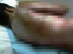 Minta Upah, Buruh Luka Bakar Akibat Disiram Air Mendidih Oleh Majikannya