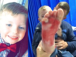 Duh, Codie Sampai Harus Cangkok Kulit Gara-gara Injak Alat Barbekyu