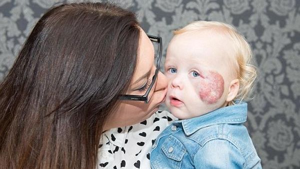 Potret Sonny, Bocah dengan Tanda Lahir Unik Sebesar Bola Kriket