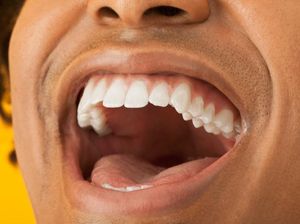 Hii, Ada Batu Kelenjar Ludah di Mulut Pria Ini