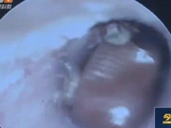 Tak Hanya Seekor, Satu Keluarga Besar Kecoa Tinggal dalam Kuping Pria ini