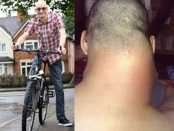 Sebulan Jatuh dari Sepeda, Muncul Tumor Sebesar Melon di Leher Pria Ini