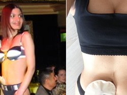 Sakit Crohn, Wanita ini Tetap Percaya Diri Meski Pakai Kantung Ileostomi