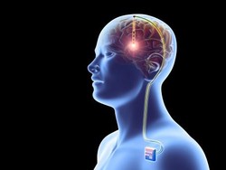 Pasang Chip di Otak, Ampuhkah Sembuhkan Parkinson?