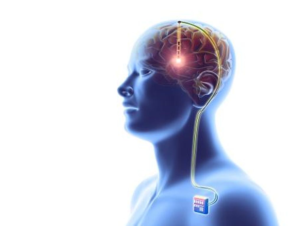 Kecerdasan Buatan Bisa Deteksi Alzheimer Kecerdasan Buatan Bisa Deteksi Alzheimer