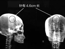Nyaris Seumur Hidup Sakit Kepala, Ternyata Ada Jarum Nyangkut di Otak Liu