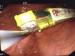 Diduga Mabuk Terpengaruh Obat, Pria Ini Tak Sengaja Telan Pemantik Api