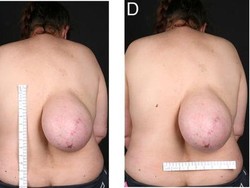 Wanita Ini Seperti Punya Payudara yang Tumbuh Besar di Punggungnya