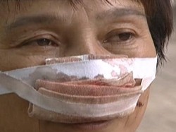 Marah karena Telepon Tak Diangkat, Suami Tega Gigit dan Telan Hidung Istri