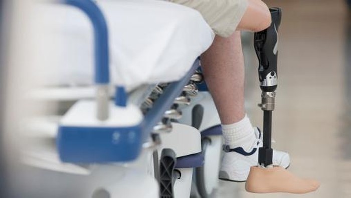 Ilustrasi kaki diamputasi. Foto: Getty Images Ilustrasi kaki diamputasi. Foto: Getty Images