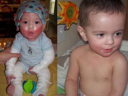 Diduga Karena Reaksi Obat, Kulit Bocah Ini Meradang dan Seperti Meleleh