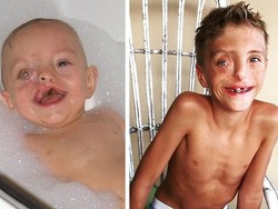 Bocah dengan Bibir Sumbing Ekstrem, Wajahnya Seperti Rusak Sebelah