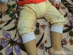 Miris! Gibran Balita di Pekanbaru Sakit Paru-paru Diduga karena Asap