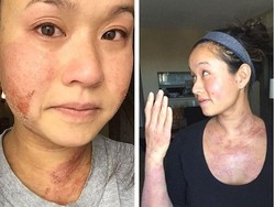 Ingin Montok dan Tampil Menarik, Wanita Ini Malah Kena Eksim