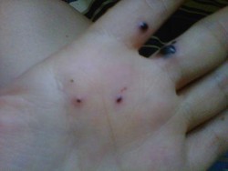 Dikira Bekas Gatal, Titik-titik Hitam di Tangan Wanita Ini Bisa Tumbuh