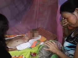 Pria Ini Tetap Bertahan Hidup Meski Sekujur Wajah Dimakan Bakteri