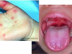 Jangkiti Warga Medan, Kenali Bedanya Flu Singapura dengan Flu Biasa