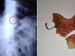 Kena Serangan Epilepsi, Pria Ini Tak Sengaja Telan Gigi Palsunya