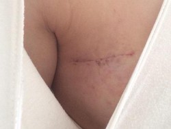 Survivor Kanker Payudara Ramai-ramai Tunjukkan Luka Operasi Mastektomi