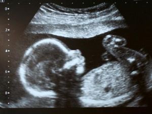 4 Penyebab Janin Suka Menendang dalam Rahim 4 Penyebab Janin Suka Menendang dalam Rahim