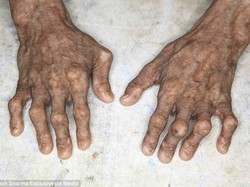 Berumur 21 Tahun, Inikah Pasien Progeria Tertua di Dunia?