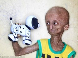 Tua Delapan Kali Lebih Cepat, Remaja 14 Tahun Bertubuh Seperti Kakek-kakek