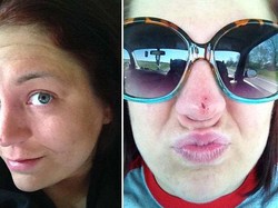 Kanker Kulit, Bree Dibuatkan Belalai sebagai Cikal-bakal Hidung Barunya