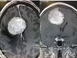 Sering Depresi, Wasit Ini Ternyata Punya Tumor di Otaknya