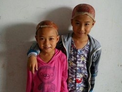 Salut! Kakak Beradik Ini Sumbangkan Kulit Kepala untuk Luka Bakar sang Ayah