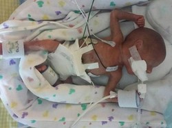 Kembar Identik Jadi Beda Hari Ultah Karena Kondisi Langka