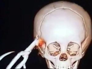 Geger! Warga Garut Temukan Tengkorak dalam Karung