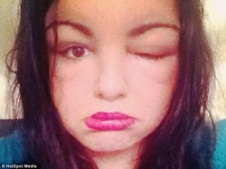 Duh! Wajah Bengkak dan Jadi Buta Sesaat Gara-gara Cat Rambut