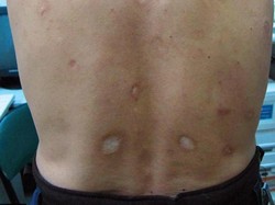 Mengenal Sifilis-Cara Pengobatannya, Ini Catatan Kasus di Jogja hingga 2023