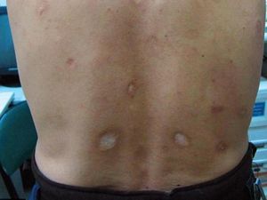 Mengenal Tahapan Perkembangan Penyakit Sifilis: Primer-Tersier Mengenal Tahapan Perkembangan Penyakit Sifilis: Primer-Tersier