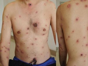 Kemenkes Catat Kenaikan Kasus Sifilis 5 Tahun Terakhir, Begini Data di Jogja Kemenkes Catat Kenaikan Kasus Sifilis 5 Tahun Terakhir, Begini Data di Jogja